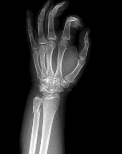 Nigthstick Fracture O Fractura Del Bastonazo
