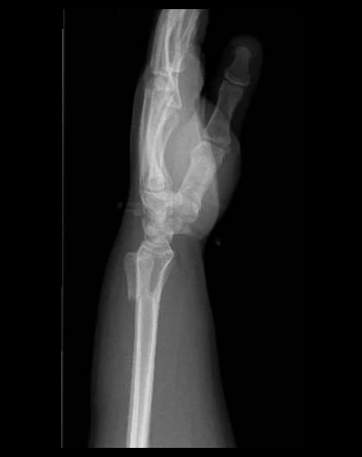 Nigthstick Fracture O Fractura Del Bastonazo
