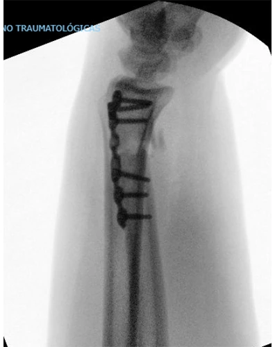 Operación Nigthstick Fracture O Fractura Del Bastonazo