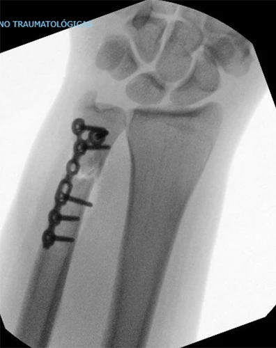 Operación Nigthstick Fracture O Fractura Del Bastonazo